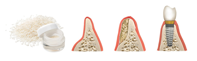 zobni implantati